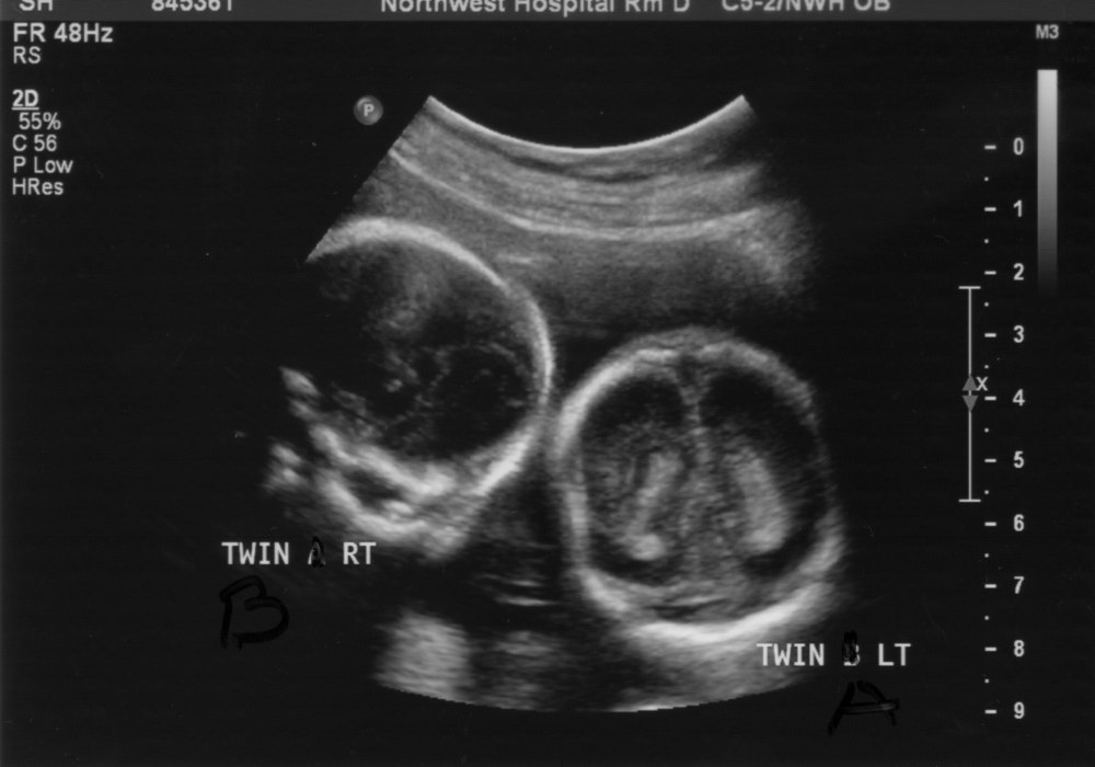 Twin Girls ultrasoundultrasound18